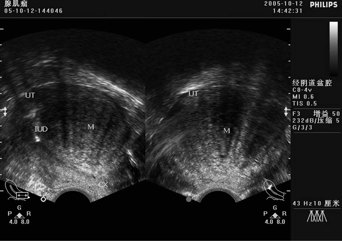 图8-5 子宫腺肌病的超声声像图