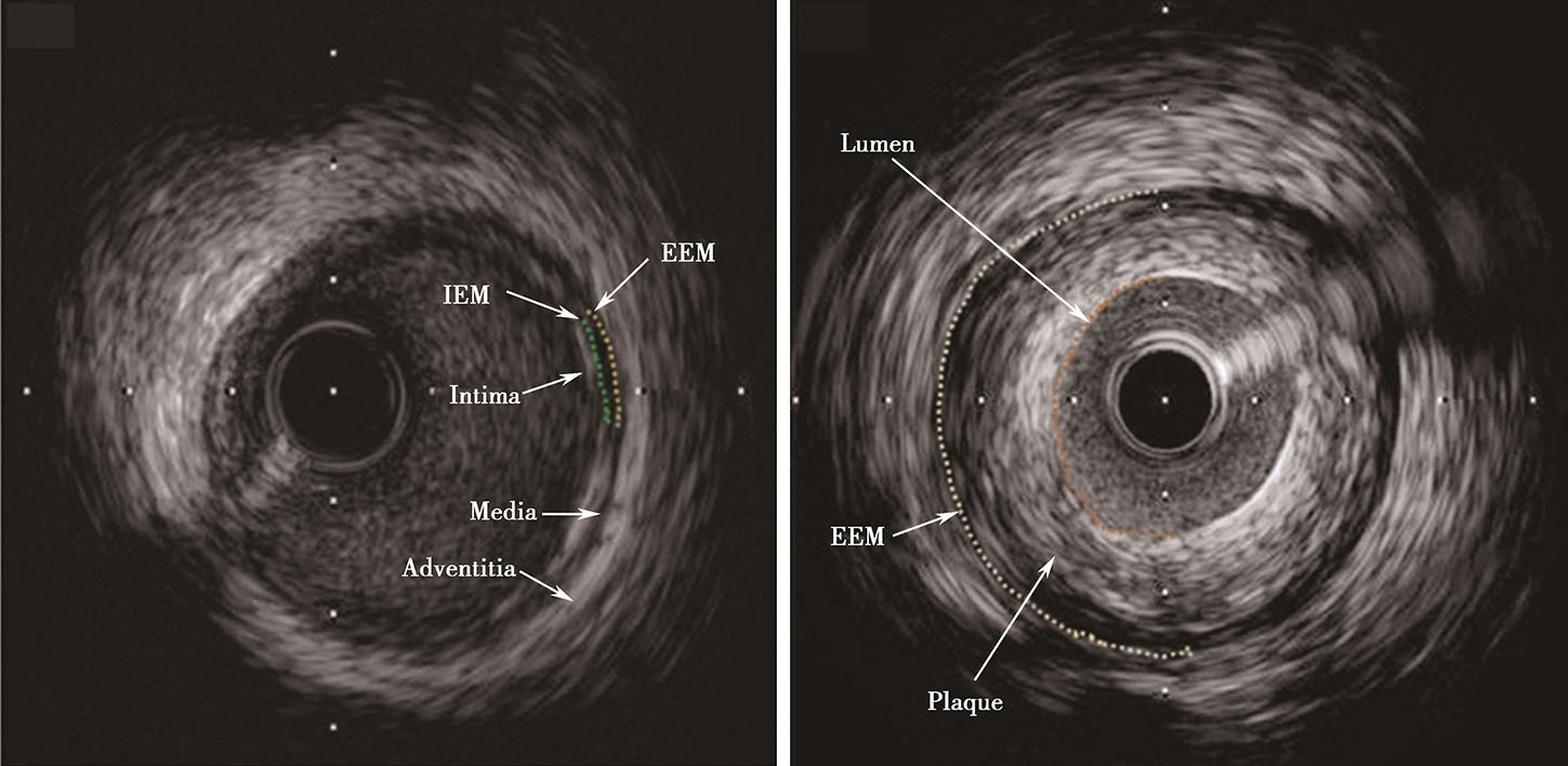 血管内超声最新章节_葛均波著_掌阅小说网
