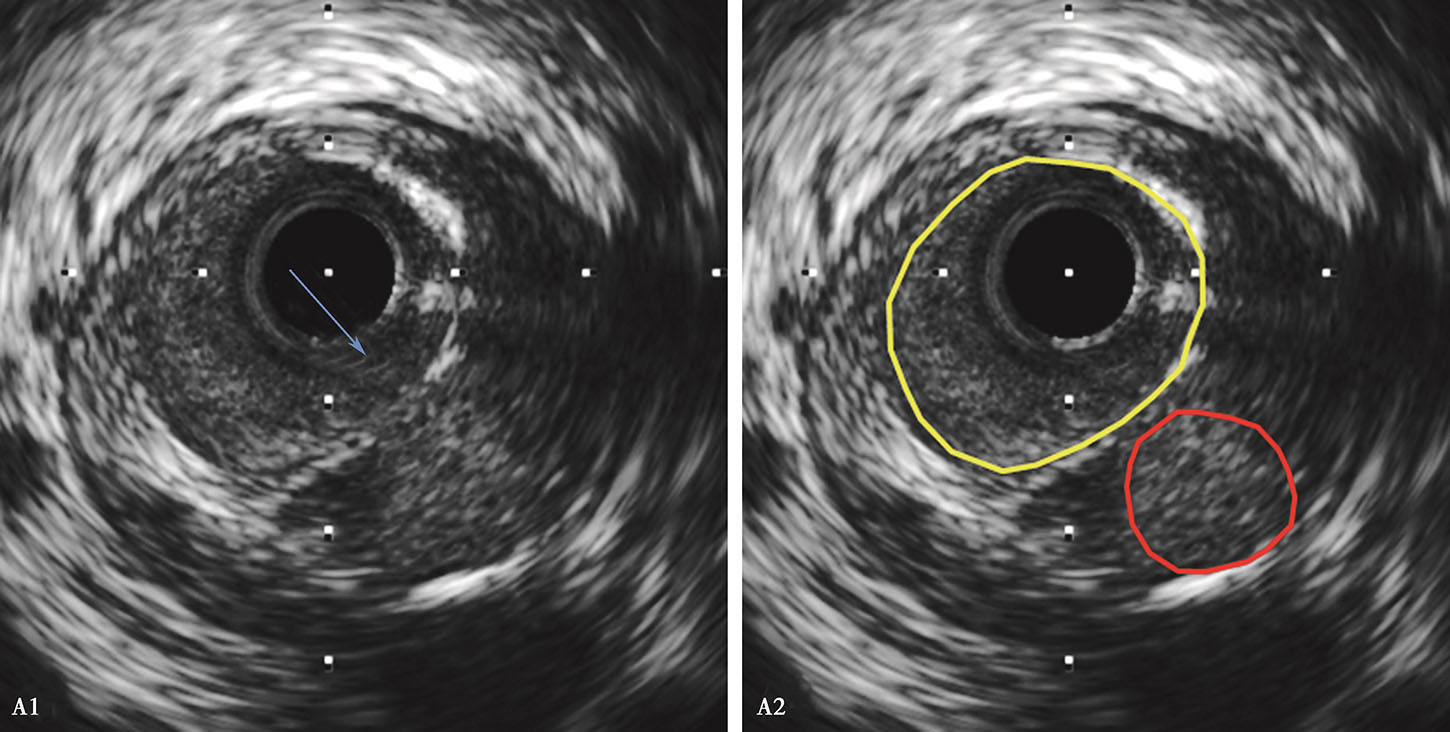 血管内超声最新章节_葛均波著_掌阅小说网