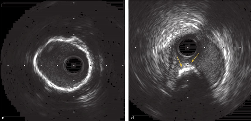 血管内超声最新章节_葛均波著_掌阅小说网