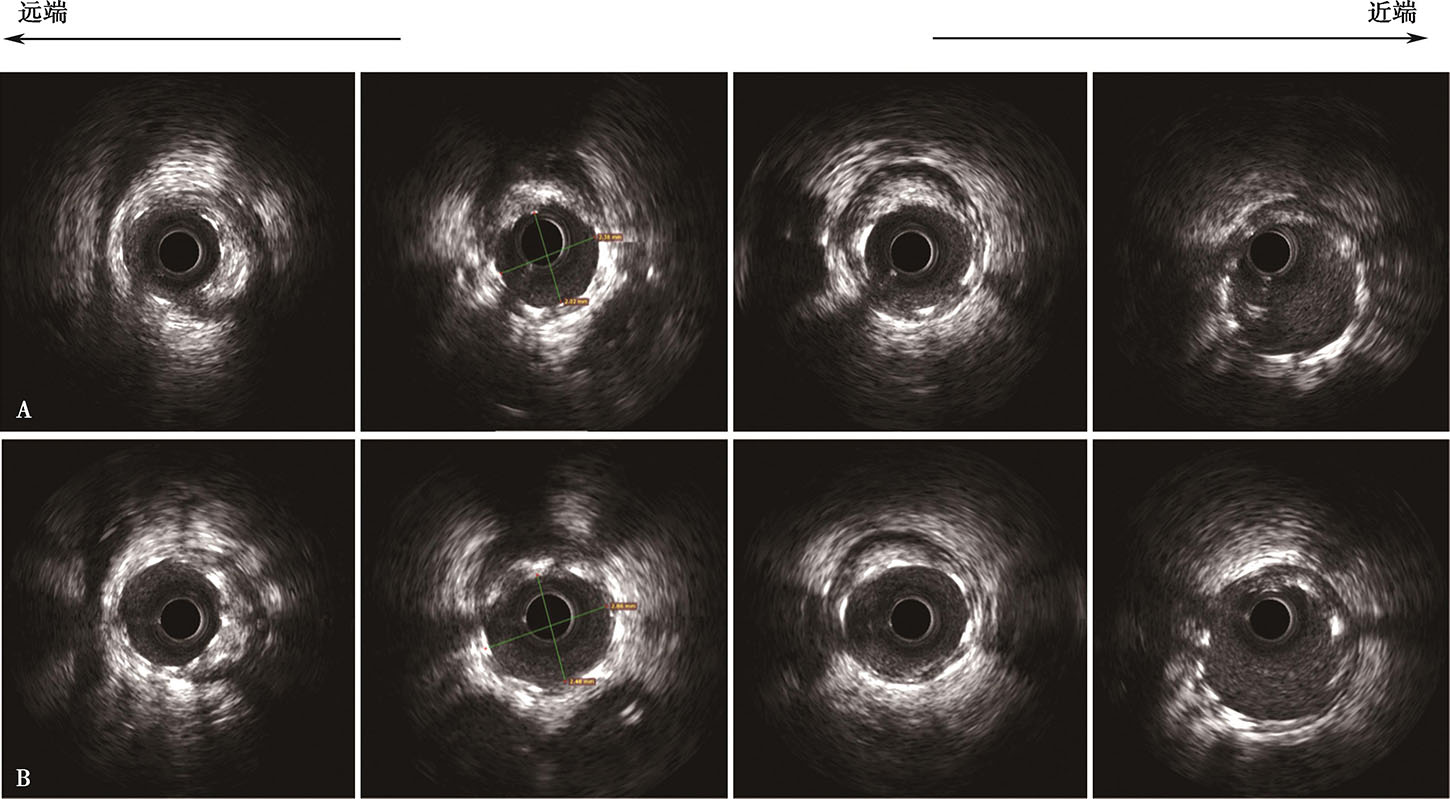 血管内超声最新章节_葛均波著