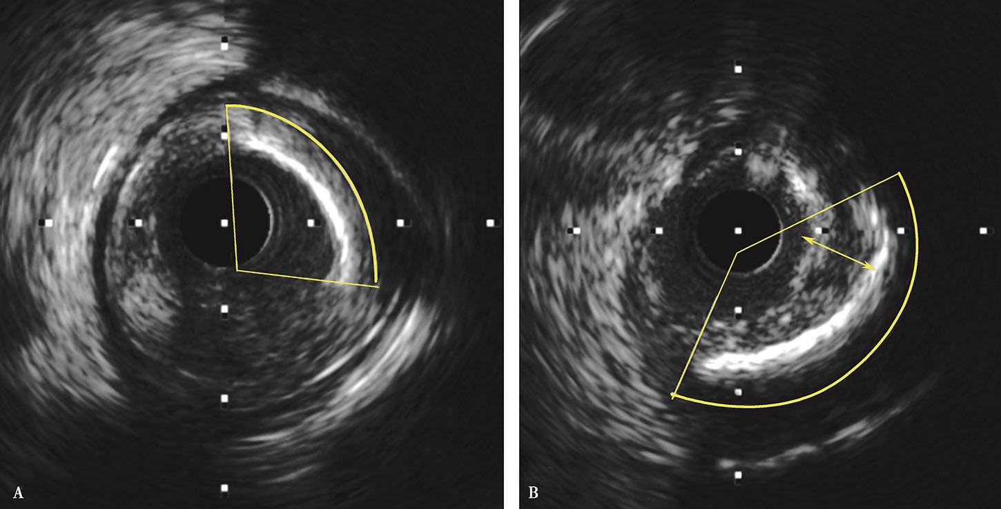 血管内超声最新章节_葛均波著_掌阅小说网