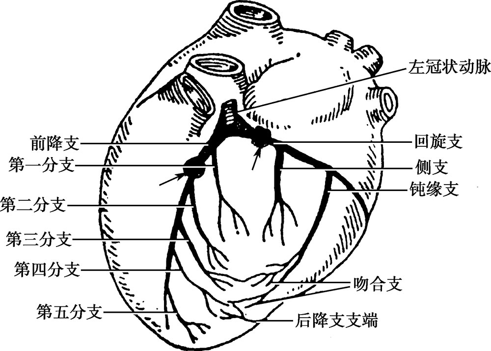 左前降支近段狭窄图片