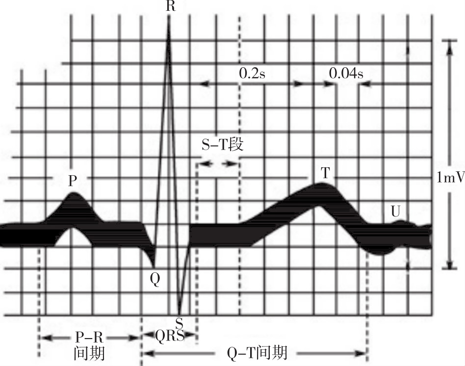 qrs波群:反映左右两心室的去极化过程,包括三个紧密相连的电位