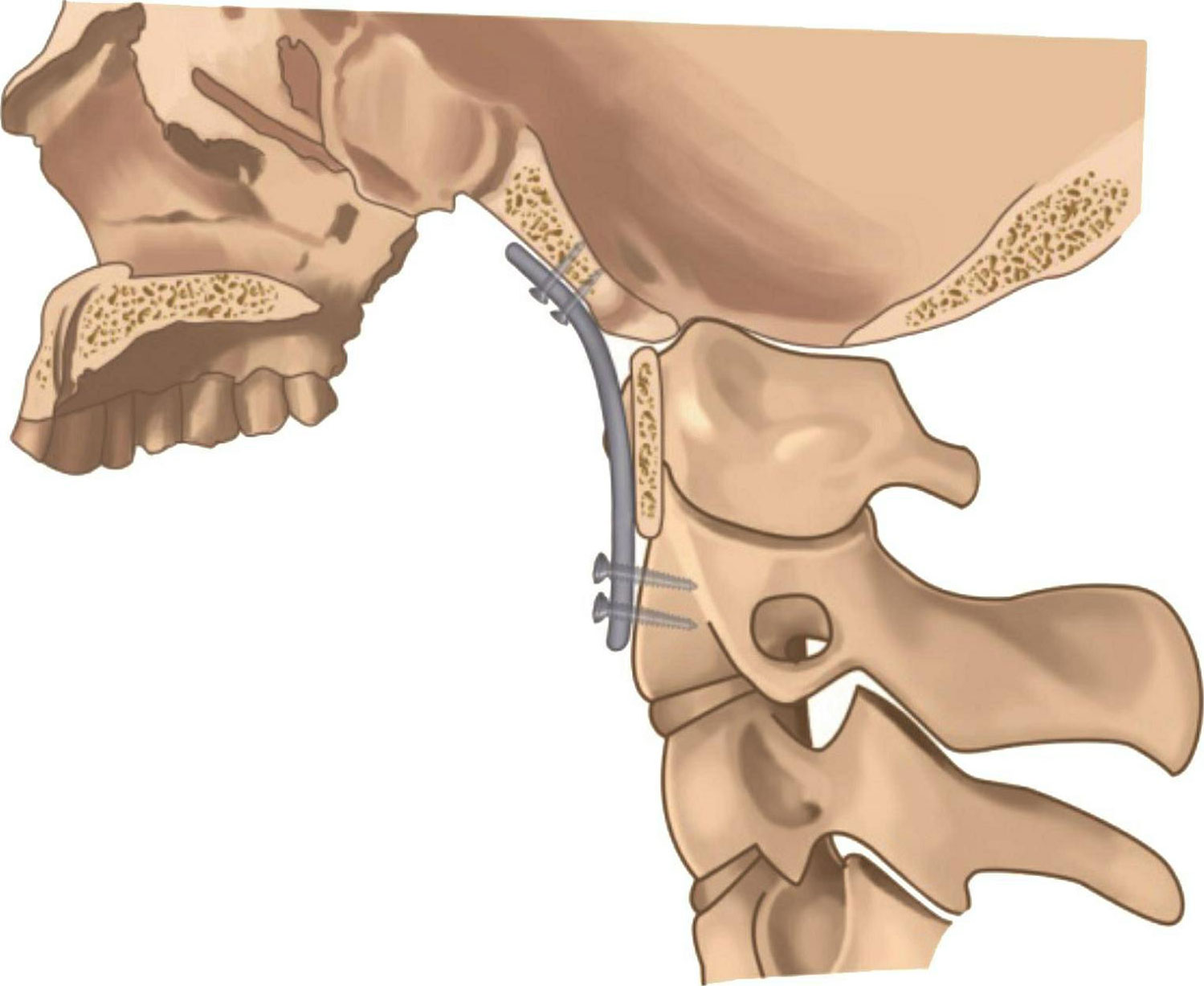 图1-5-1 自体髂骨块植骨钢板内固定
