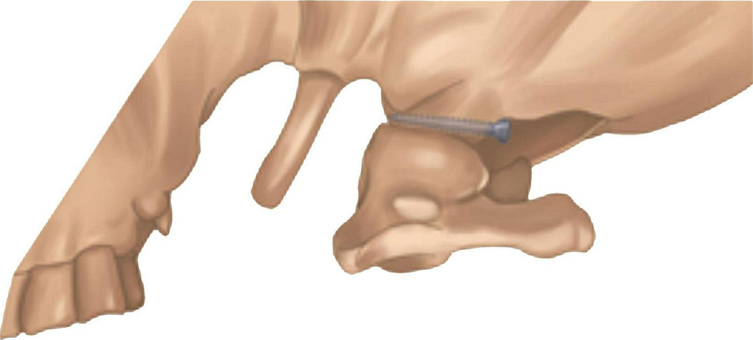 图1-6-1a 枕骨髁螺钉固定示意图(侧位观透视图)