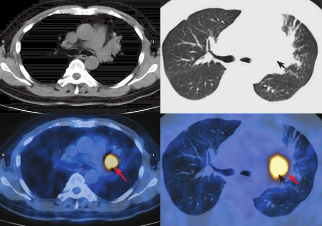 图2-1-11 中央型肺癌              18            f-fdg pet/ct显 