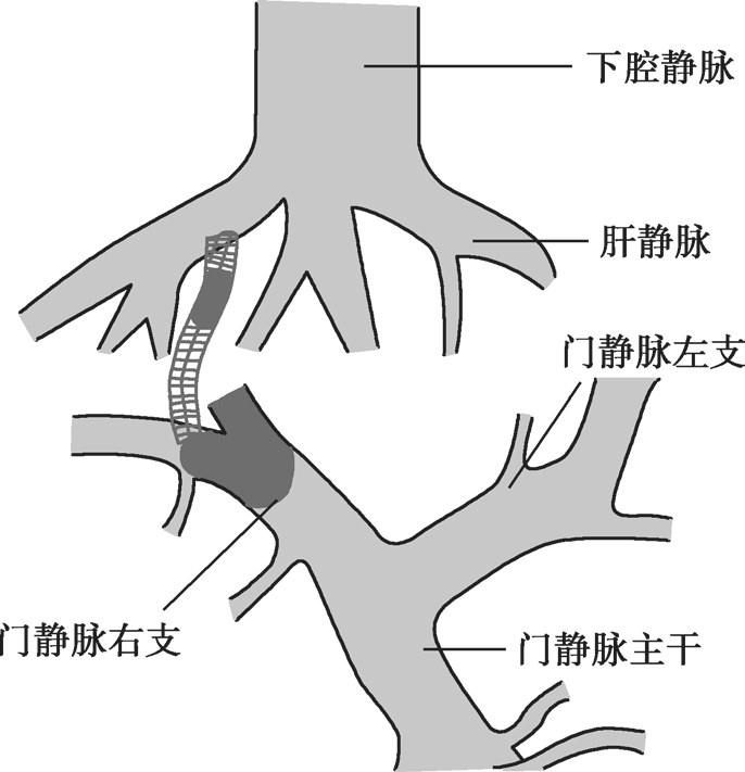 门静脉系统血栓介入治疗经验与技巧最新章节